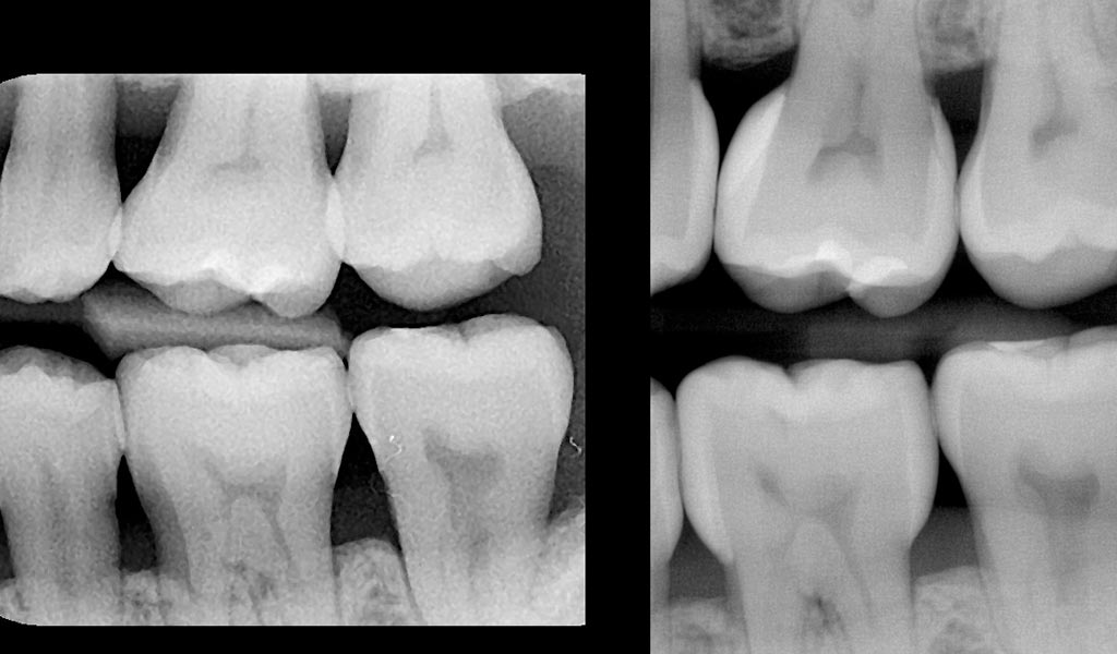 How Bioclear Empowers Dentists To Treat Black Triangles Optident